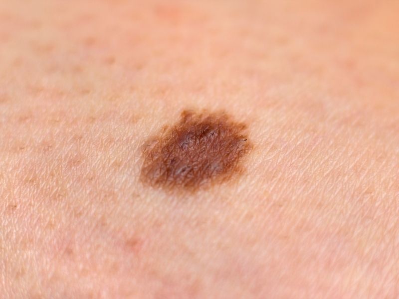 Lunares y cáncer de piel